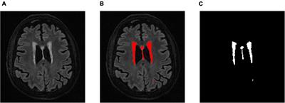 Brain white matter hyperintensity lesion characterization in 3D T2 fluid-attenuated inversion recovery magnetic resonance images: Shape, texture, and their correlations with potential growth